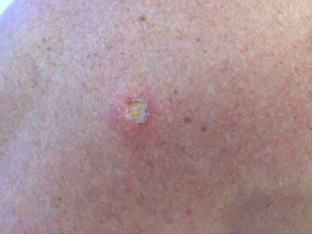 Pendelfibrom-sofort_nach_der_Behandlung__mit_K_Laser_Blau_2.jpeg