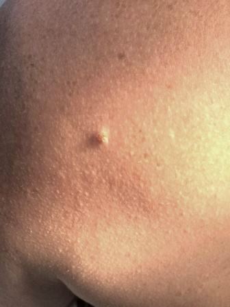 Pendelfibrom-vor_der_Behandlung_mit_K_Laser_Blau_quer.jpeg