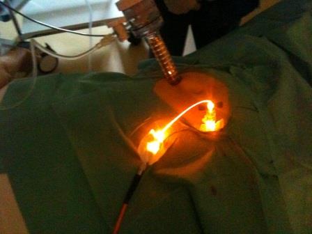 intraabdominelle_PDT.jpeg